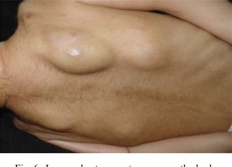 Figure 6 From A Case Report Of Juvenile Hyaline Fibromatosis Semantic