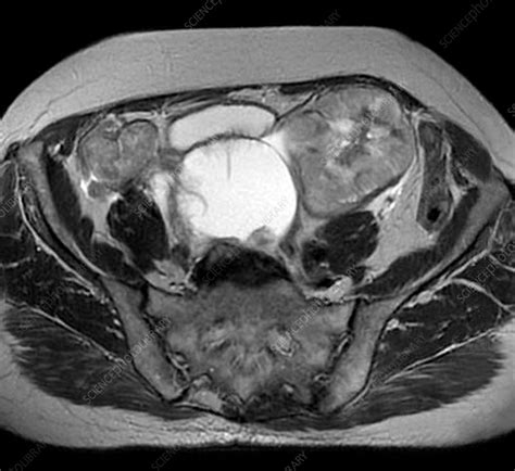 Bilateral Ovarian Cancer Mri Scan Stock Image C0345656 Science