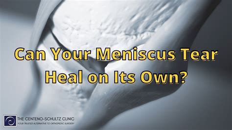 How To Heal A Torn Meniscus Naturally Centeno Schultz