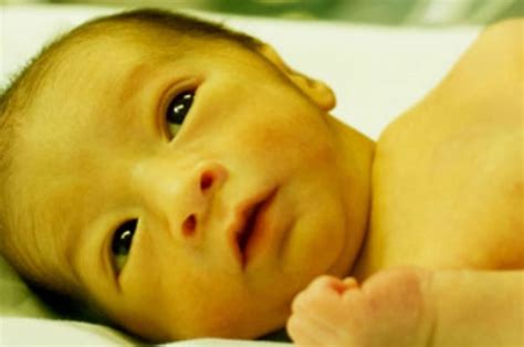 Jaundice In Newborns Causes Signs Symptoms Diagnosis And Treatment