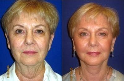 Photocross - LifeStyle: Lifestyle Lift: What is It and How ...
