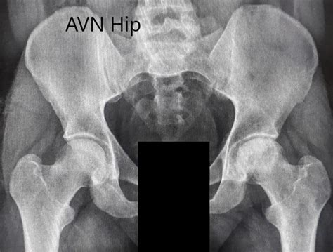 Case Study Left Total Hip Replacement In A 55 Year Old Male With