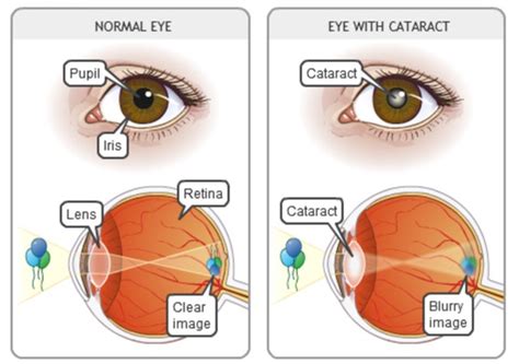 Cataract Susrut Eye Foundation And Research Centre