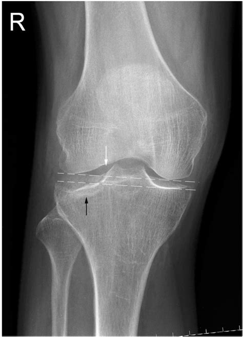 Lateral Tibial Plateau Fracture Prognosis