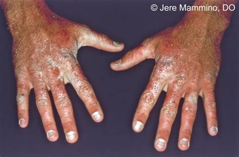 Hand Rashes American Osteopathic College Of Dermatology Aocd Rash