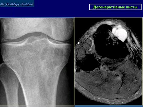 Subchondral Degenerative Cysts Subchondral Bone Cyst Symptoms Causes