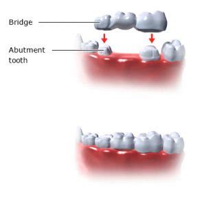 Mudah dibentuk dan dihaluskan sesudh kerangka ini fungsinya menahan gigi berada di tempatnya. Pemasangan Gigi Palsu : Fungsi - Prosedur dan Perawatan ...