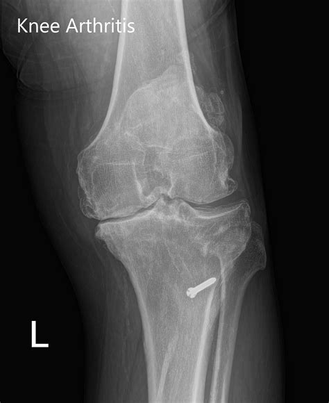 Case Study Custom Left Knee Replacement In A 59 Year Old Female