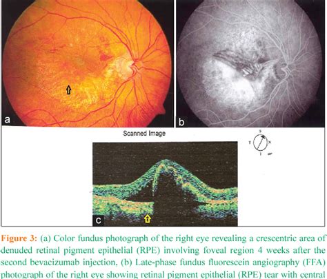 Figure 1 From Retinal Pigment Epithelial Tear After Intravitreal