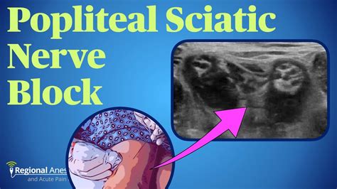 Popliteal Sciatic Nerve Block Youtube