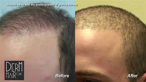 Fue Hair Transplant Buzz Cut After Body Hair Transplant And Strip