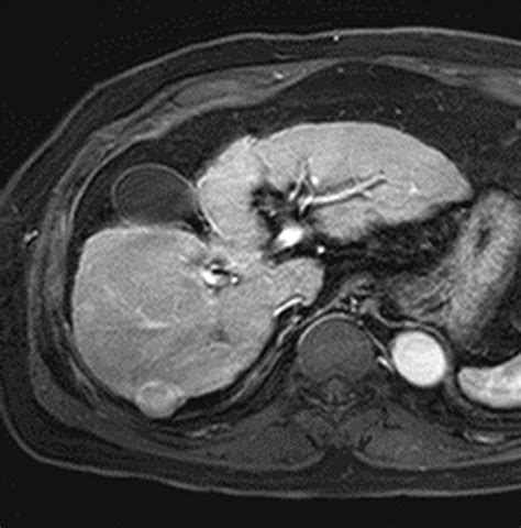 Ct And Mr Imaging Diagnosis And Staging Of Hepatocellular Carcinoma