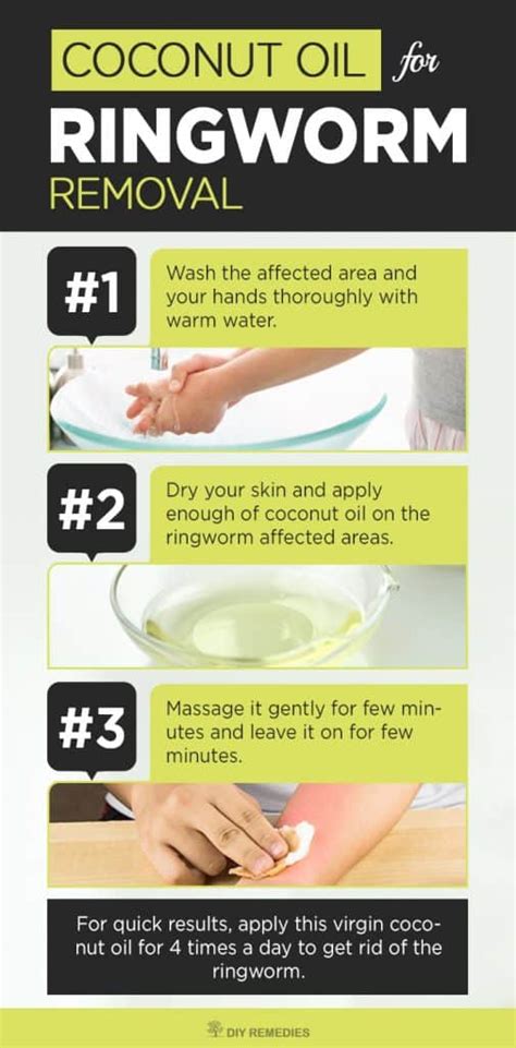 How To Cure Ringworm Using Coconut Oil