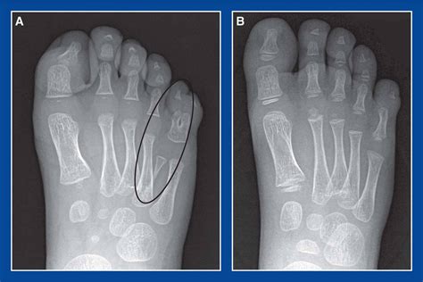 Toesforefoot Foot Malformations Principles And Management Of