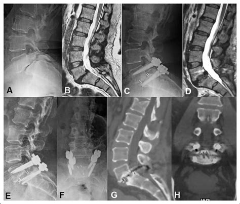 Images Of L5s1 Grade Ii Isthmic Spondylolisthesis A Lateral Plain