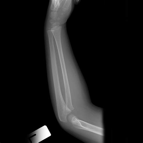 Normal Forearm X Ray 5 Year Old Image