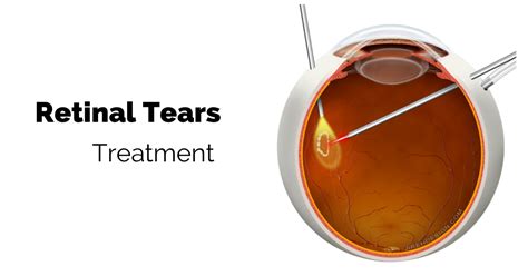 Retinal detachment is a sight threatening condition with an incidence of approximately 1 in 10000. If you have a retinal tear - Retina Specialist | Fairfax ...