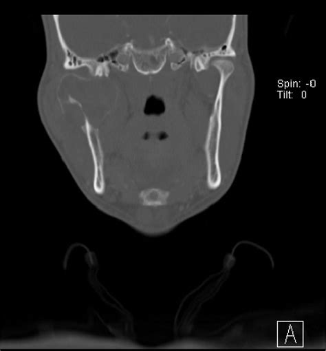 Rare Mandibular Condylar Pathology And New Surgical Approach Intraoral