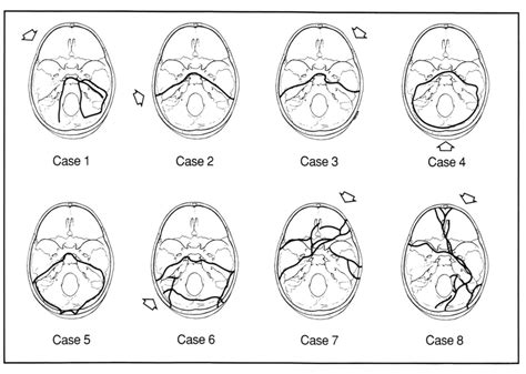Pattern Of Basal Skull Fracture In Eight Download Scientific Diagram