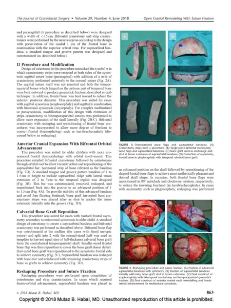 Surgical Outcome After Less ‘‘rigid Fixation In Open Cranial Vault