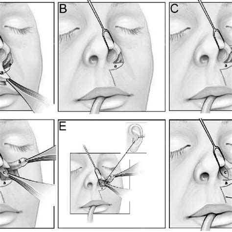 Pdf Repair Of Nostril Stenosis Using A Triple Flap Combination