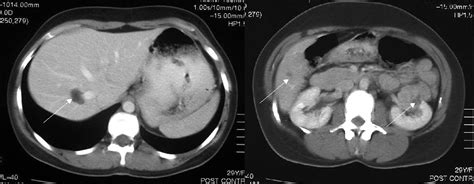 Liver Lesions Causes