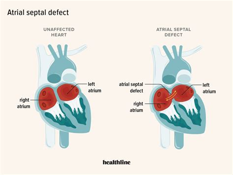 Atrial Septal Defect Definition Causes Treatment Outlook