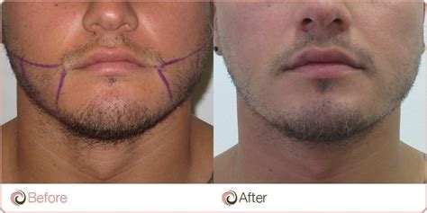 Lower Face Liposuction Before And After Review Our Cases