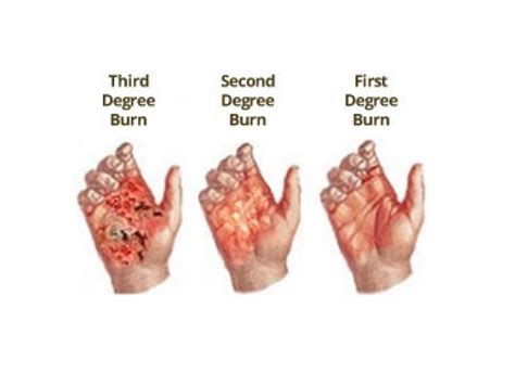 Caused by contact with flames, hot liquids or chemicals. We help burn injury victims and their families get the ...