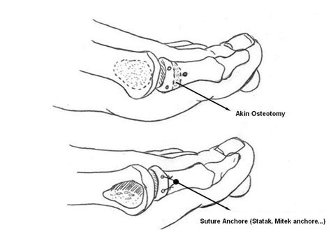 Schematic Of The Akin Osteotomy Download Scientific Diagram