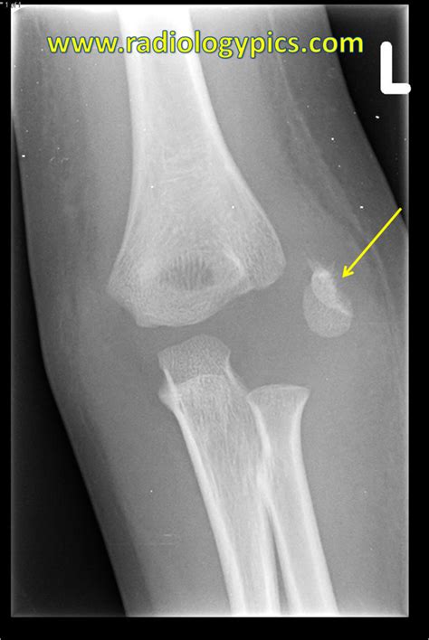 Lateral Epicondyle Avulsion Fracture Radiologypicscom