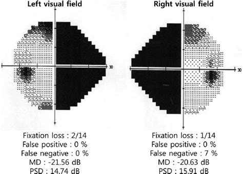 Computerized Visual Field Testing Reagan Has Gonzalez