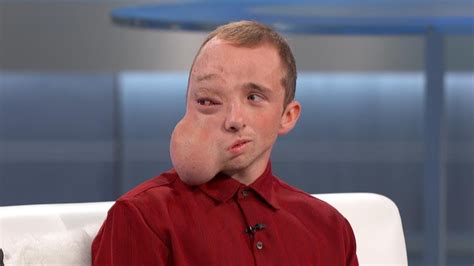 The Doctors Welcome Man Plagued By Facial Tumor Youtube