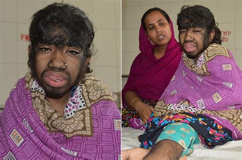 Werewolf Syndrome This Girl S Rare Condition Will Creep You Out