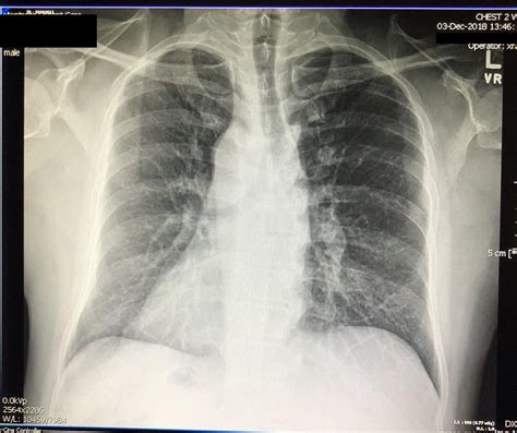 When The Cxr Reveals A Rare Find Dextrocardia With Situs Inversus
