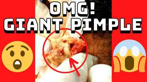 Explosion Pimple Popping Acne Pus Cyst Blackheads Bursting Removal Big Giant 26 😱😱😱 Youtube