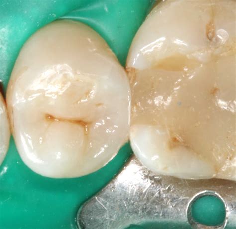 Löcher im zahn müssen behandelt und mit füllungen versehen werden. Karies zwischen den Zähnen | Zahnnotizen