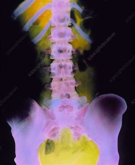 Coloured X Ray Of Normal Spine T 10 To Pelvis Stock Image P116