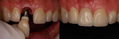 The average cost of a crown is $825, with or without dental insurance coverage. What is the Typical Cost of a Dental Crown?