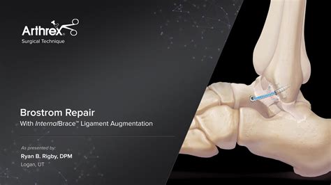Arthrex Brostrom Repair With Internalbrace Ligament Augmentation