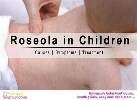 Roseola In Children Causes Symptoms And Treatment