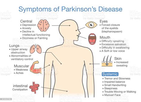Parkinson's symptoms usually begin gradually and get worse over time. Parkinsons Disease Symptoms And Signs Stock Illustration ...