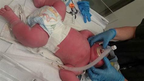 Is This Nzs Biggest Baby Infant Weighing 74kg Born In