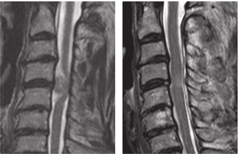Case 22 A Preoperative T2 Weighted Mri Of The Cervical Spine