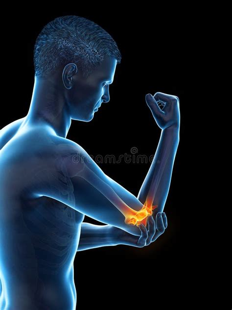 A Man With Painful Elbow Stock Illustration Illustration Of Anatomical