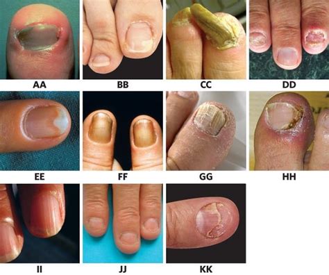 Cool 5 Types Of Nail Disorder Ideas Inya Head