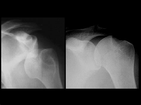 Aneurysmal Bone Cyst Findings Expansile Lytic Lesion Of