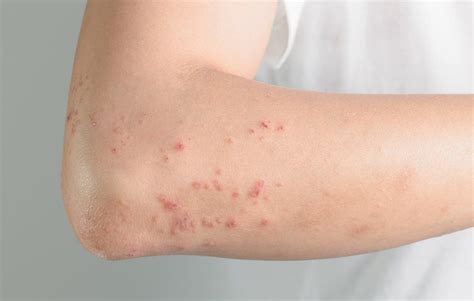 Itchy Hives On Body And Arms Patient Webinars