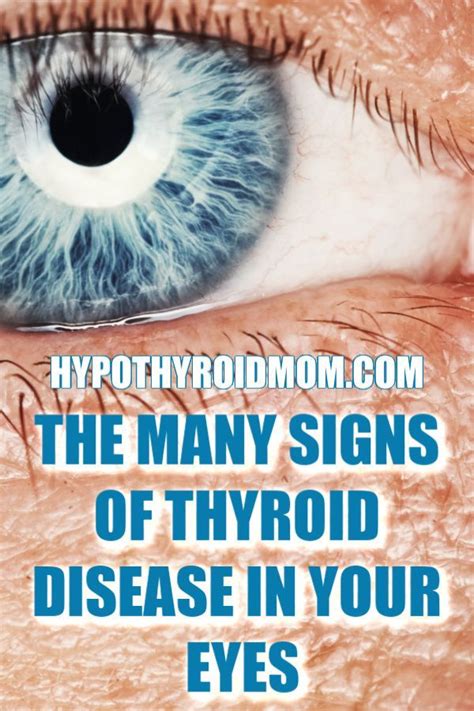 Thyroid Disease And Your Eyes Thyroid Disease Symptoms Thyroid