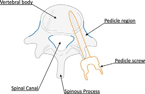 Example Of Pedicle Screw Insertion The Screw Is Inserted To A Download Scientific Diagram